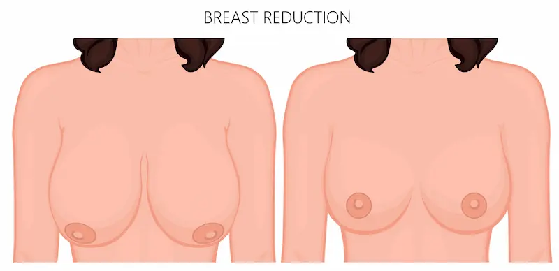 breast reduction turkey before after