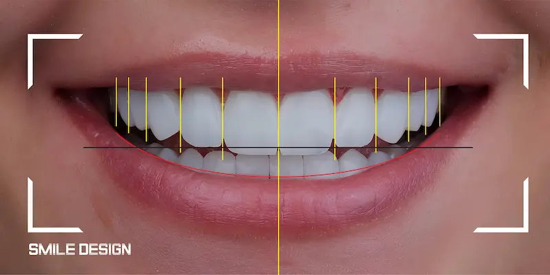 طب الأسنان التجميلي