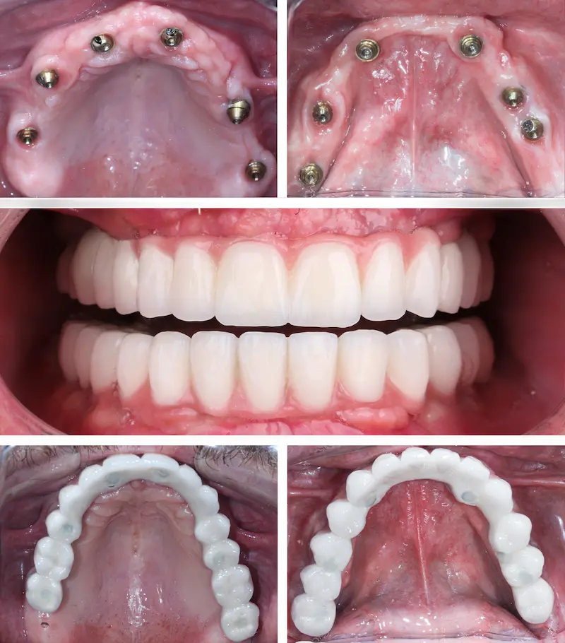 Dental Implants Turkey Cost