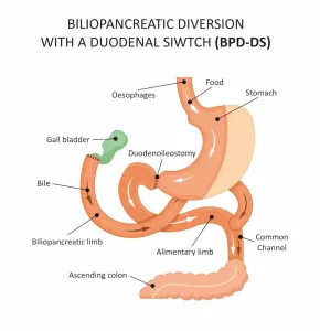 Duodenal Switch in Turkey