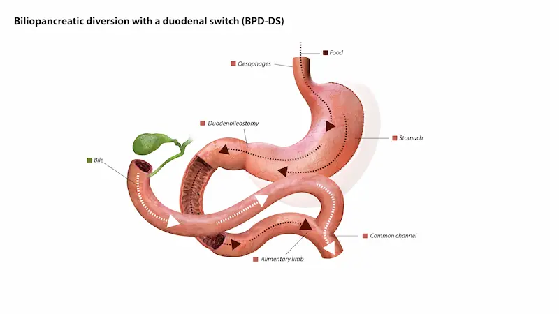 Duodenal Switch SADI-S Surgery