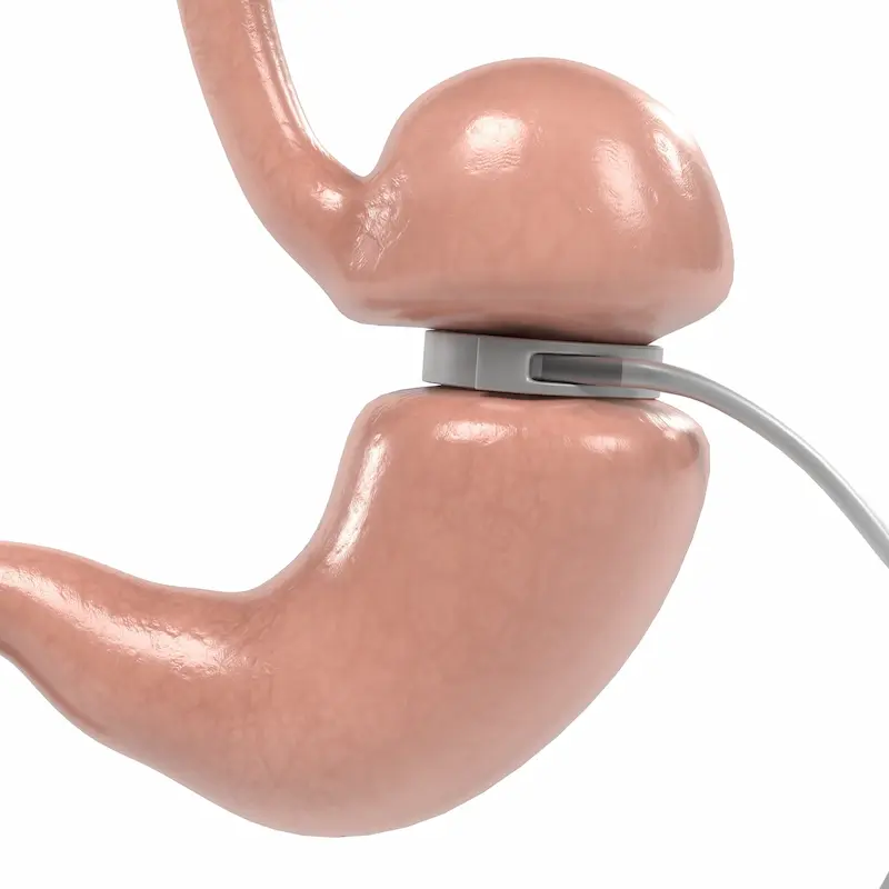 Gastric Band in Turkey