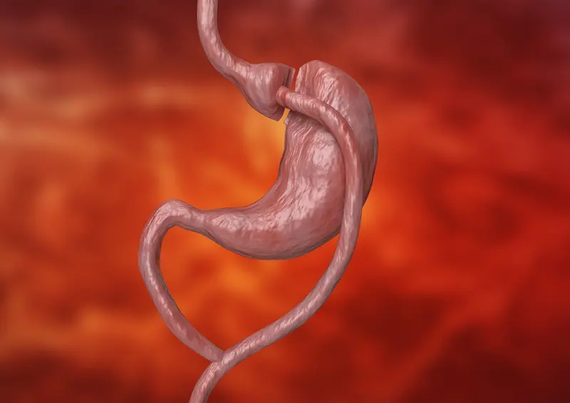Gastric Bypass Before and After