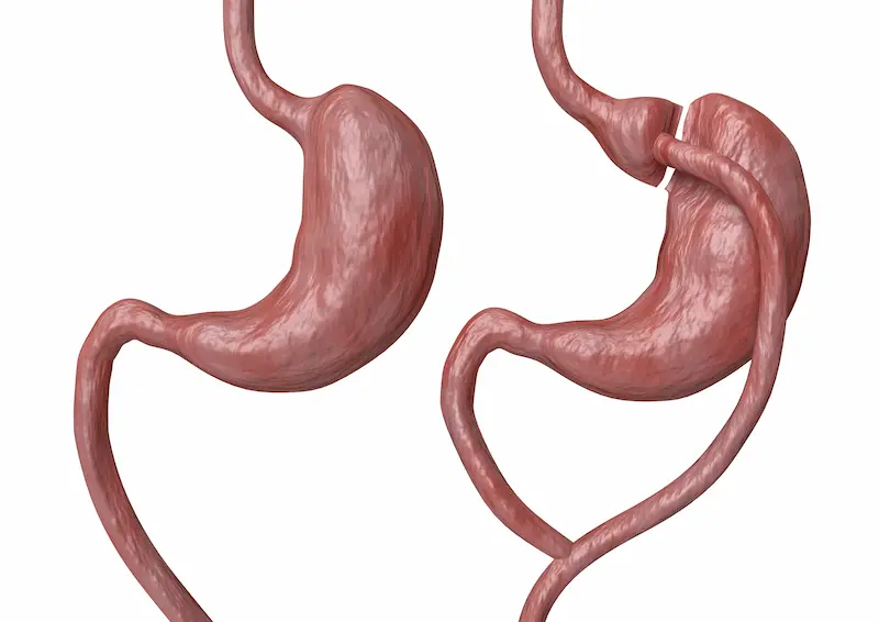 Gastric Bypass Surgery Cost Turkey