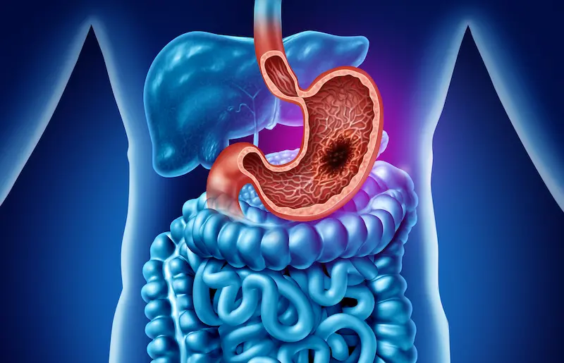 Gastric Cancer: Common Condition for Stomach Resection