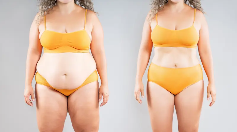 Gastric Sleeve Before and After