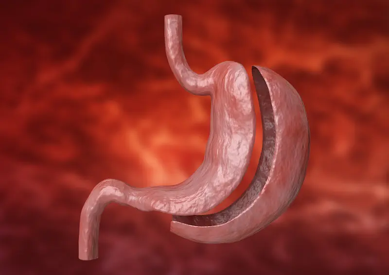 Gastric Sleeve Surgery