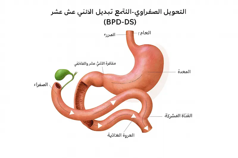 جراحة تبديل الاثني عشر