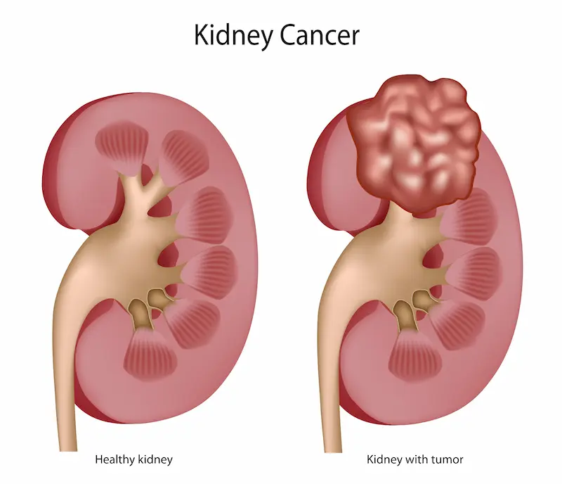 Kidney Cancer