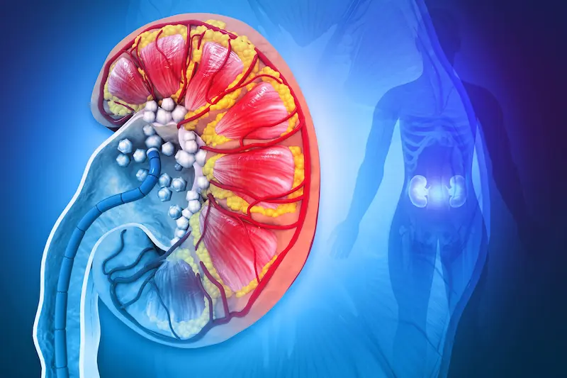 Kidney stone removal