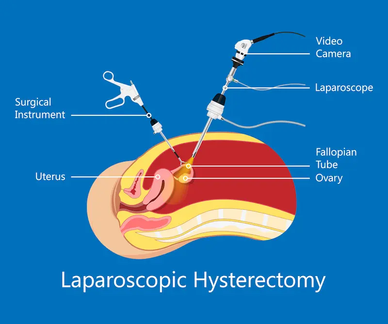 Laparascopic Hysterectomy