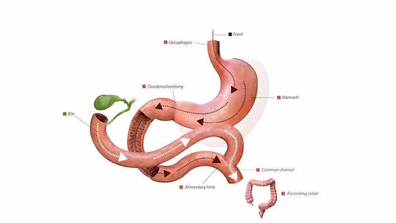 Metabolic Surgery Cost Turkey