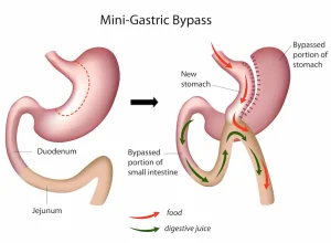 Mini Gastric Bypass in Turkey
