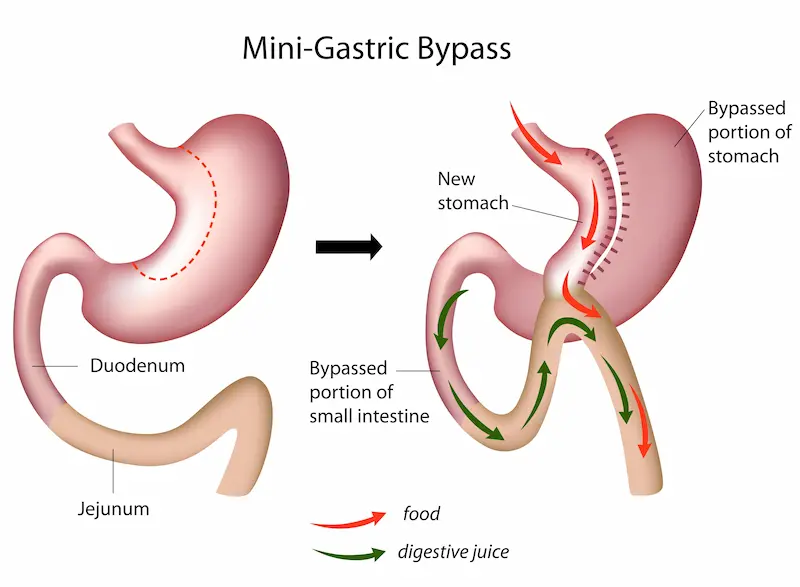 Mini Gastric Bypass in Turkey