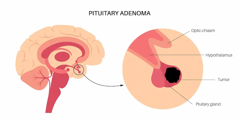 Pituitary adenoma (tumor) in the human brain