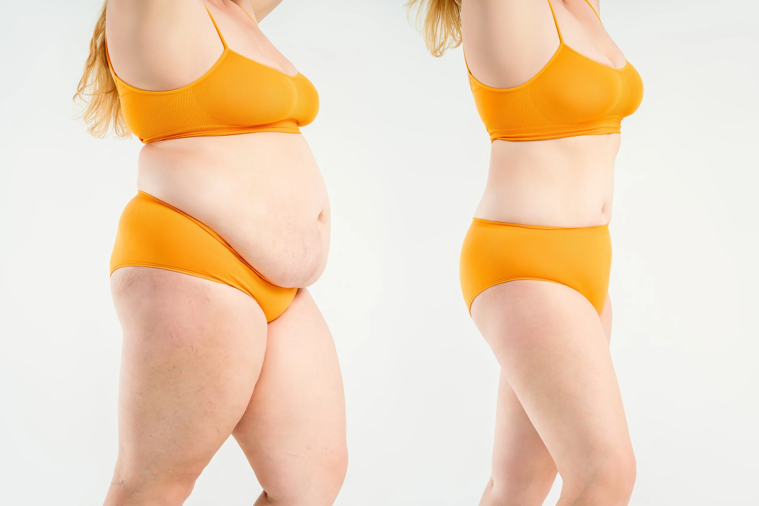 Post Bariatric Surgery in Turkey