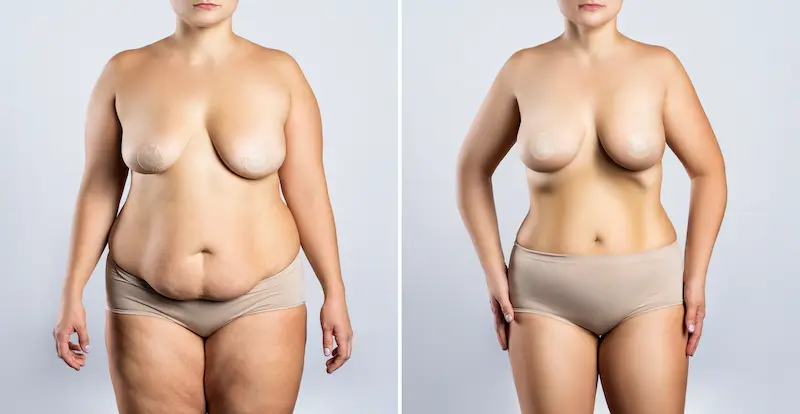 post bariatric surgery turkey before after