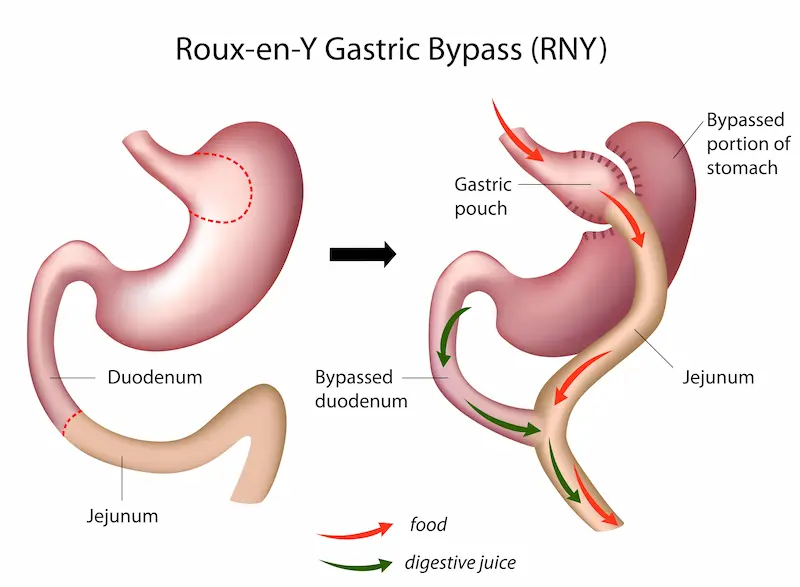 Roux-en-Y Gastric Bypass (RNY)