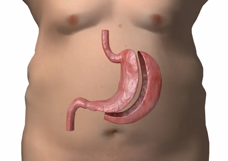 Sleeve Gastrectomy in Turkey
