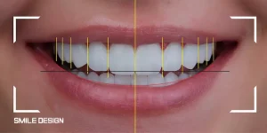 طب الأسنان التجميلي في تركيا