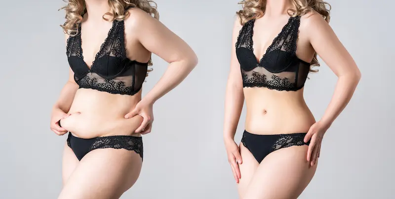 Tummy Tuck Before and After