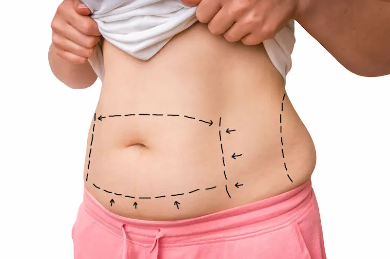 Tummy Tuck in Turkey (Abdominoplasty)