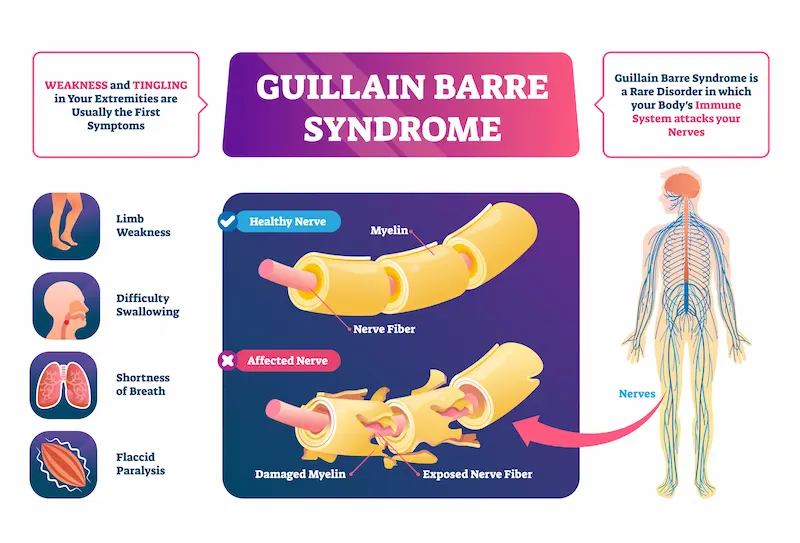 Guillain Barre syndrome