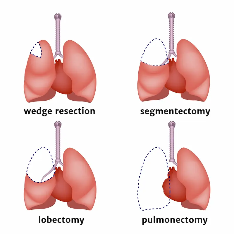 Types of lung resection