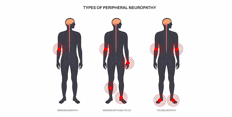 Types of peripheral neuropathy