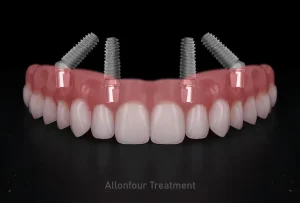 All On 4 Dental Implants in Turkey