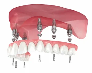 All On 6 Dental Implants in Turkey