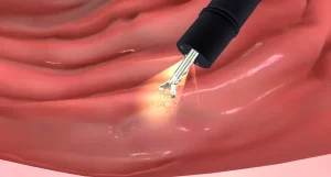Biopsy in Turkey