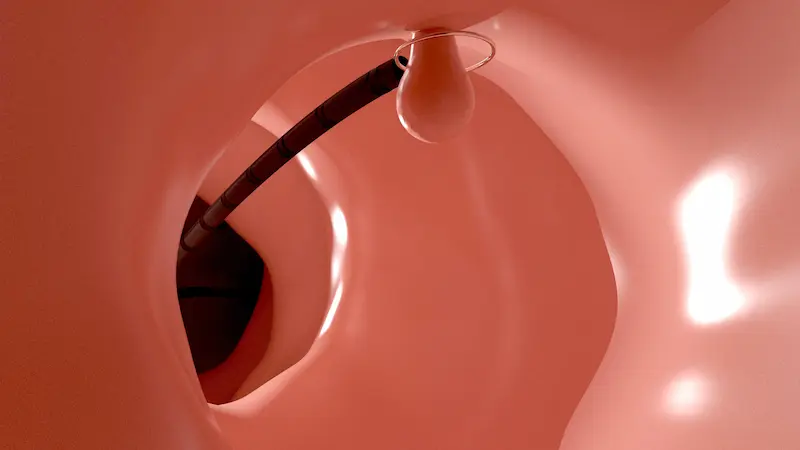 Colonoscopy Polyps