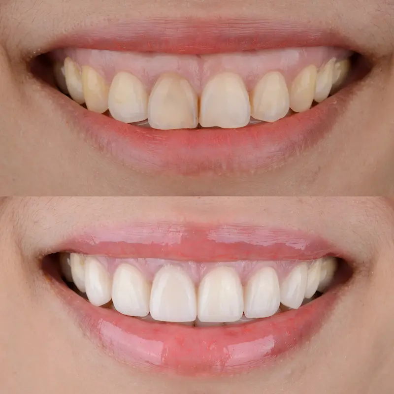 Crown Lengthening Before and After