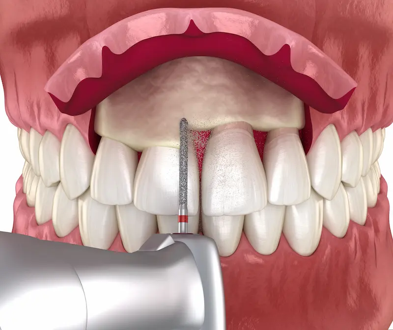 Crown Lengthening in Turkey