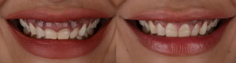 Crown Lengthening Procedure