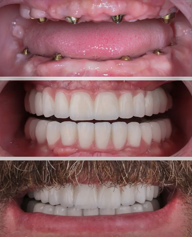Dental All On 4 Implants Cost