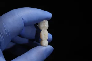 Dental Bridge in Turkey