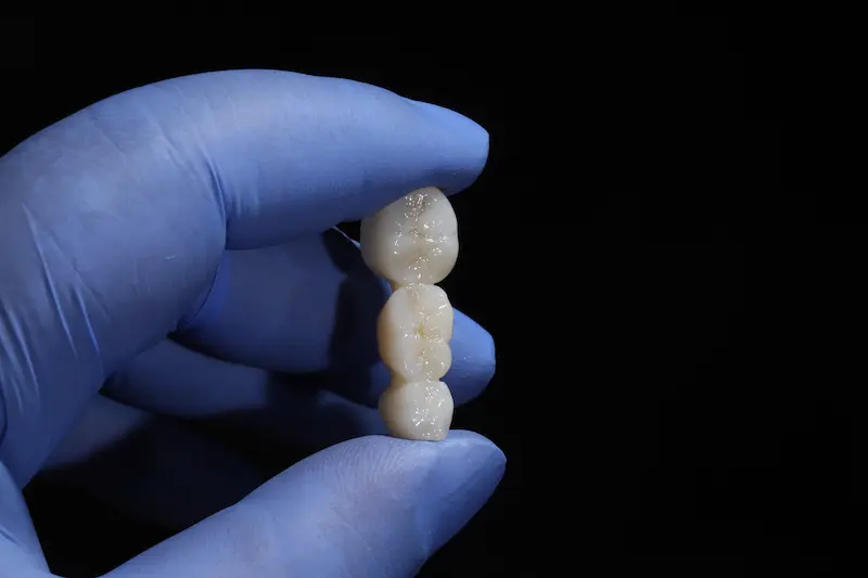 Dental Bridge in Turkey