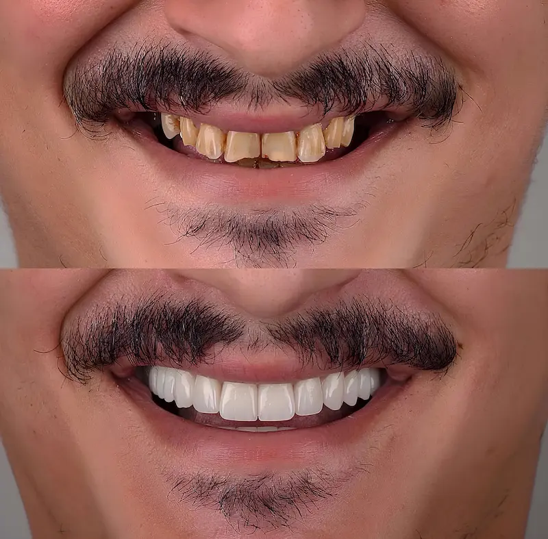 Dental Veneers Cost in Turkey