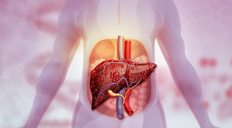 Liver Cancer Treatment Cost in Turkey