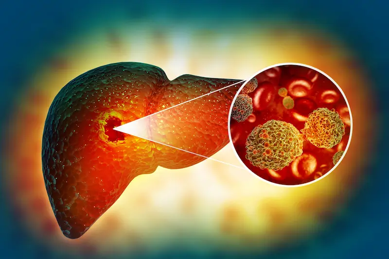 Liver Cancer Treatment in Turkey