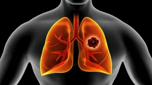Lung cancer surgery in Turkey