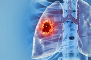 Lung Cancer Treatment in Turkey