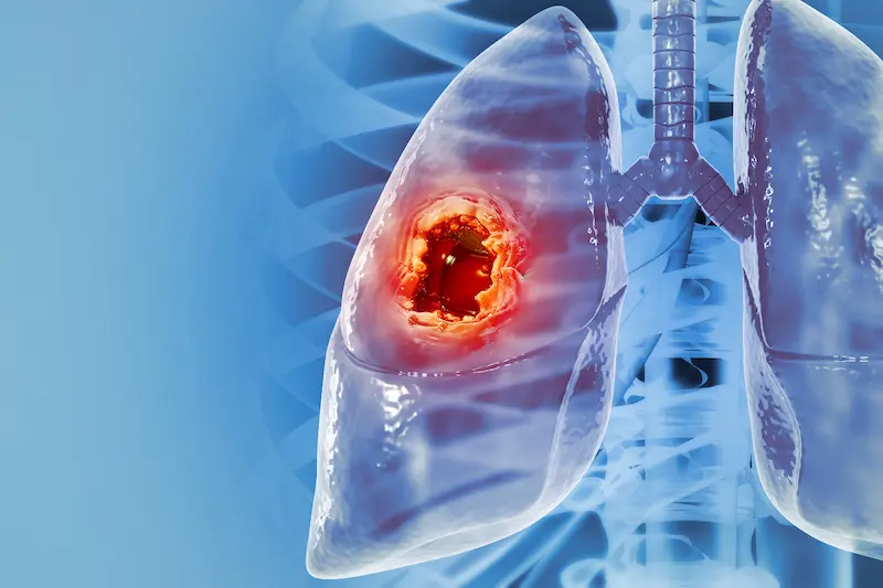 Lung Cancer Treatment in Turkey