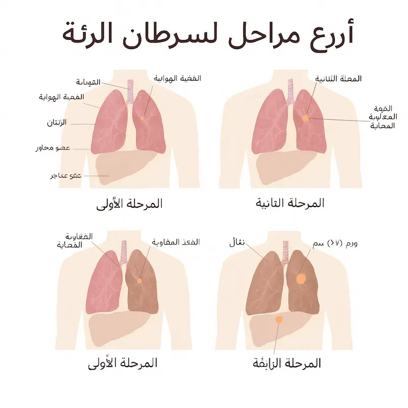 مراحل سرطان الرئة