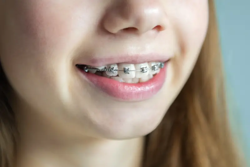 Orthodontic for Kids