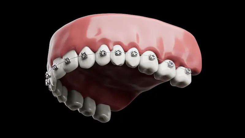 Orthodontics in Turkey