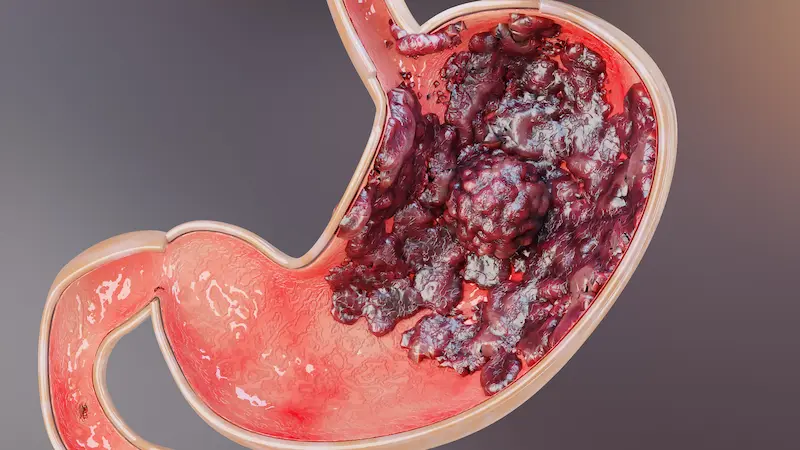 Stages of Bowel Cancer