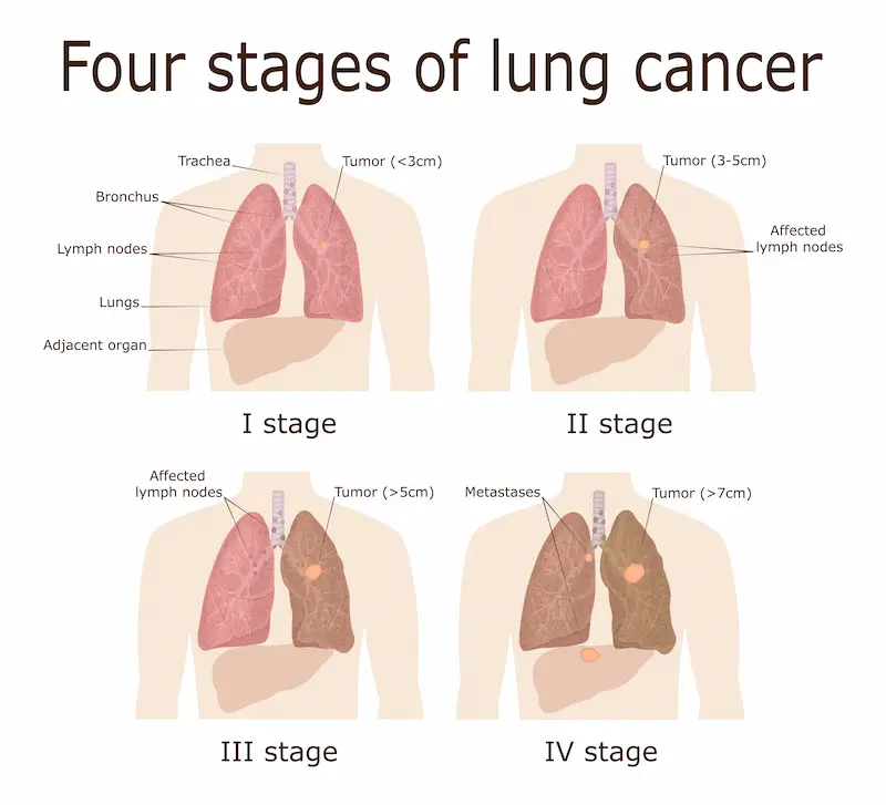 Four stages of lung cancer